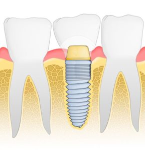 Dental Implant Placement - Buckingham Dental Austin